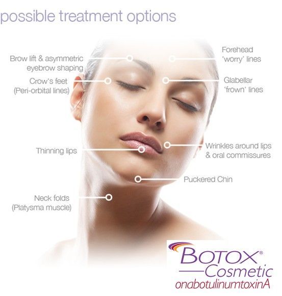 Botox Face Chart