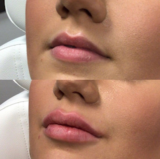 February Newsletter | Lip Filler Treatment | Refined Aesthetics Med Spa