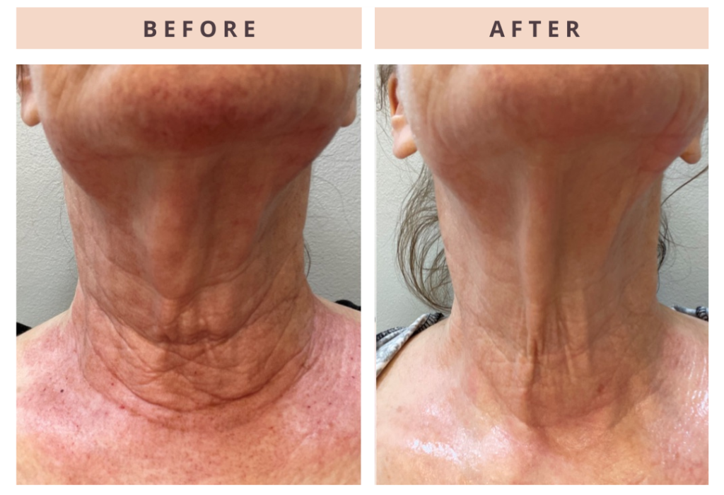 sandpointmedspa.before&after.1 by sandpointmedspa in Sandpoint, ID