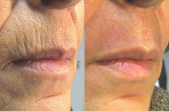 sandpointmedspa.before&after.2 by sandpointmedspa in Sandpoint, ID