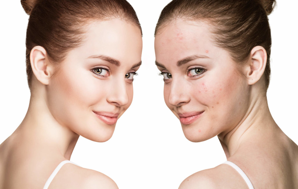 Microneedling-services-sandpoint-ID by sandpointmedspa in Sandpoint, ID